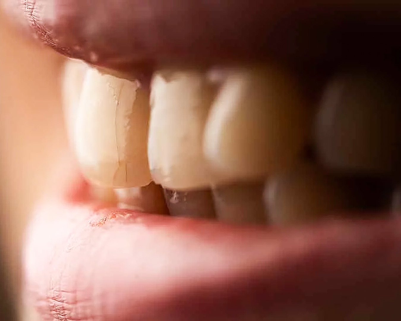 Microfracturas Dentales