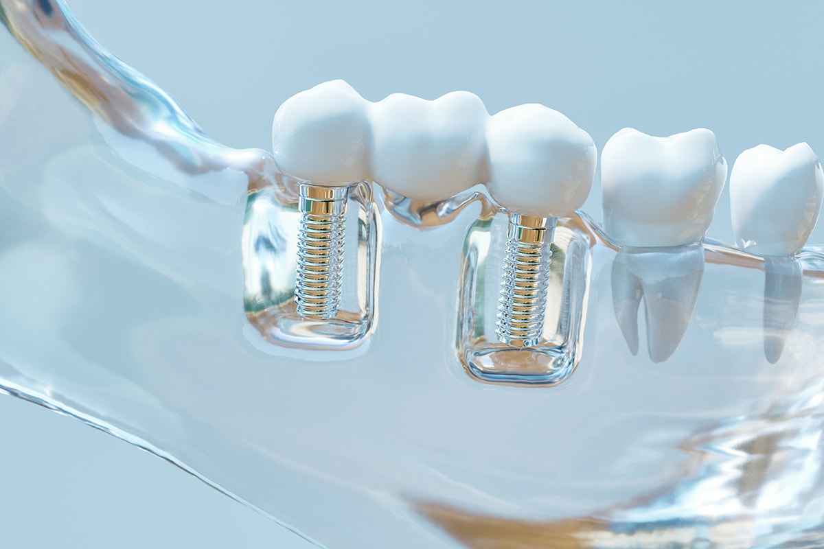 Implantes Paso