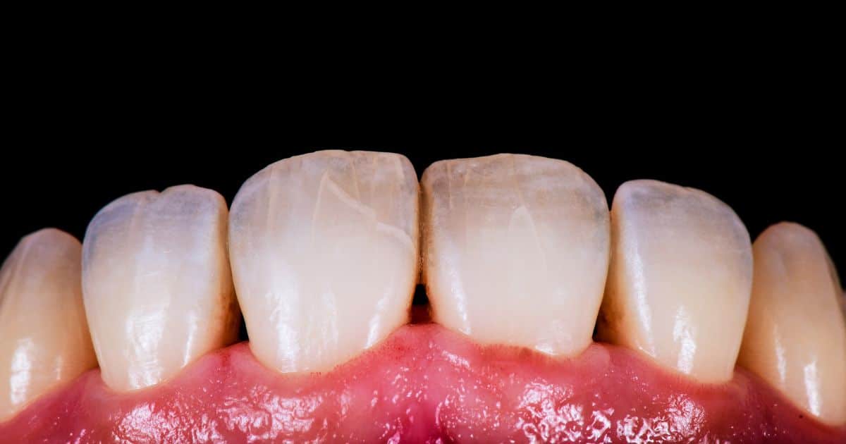 Dientes Agrietados
