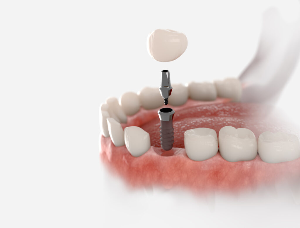 fases del tratamiento con implantes dentales