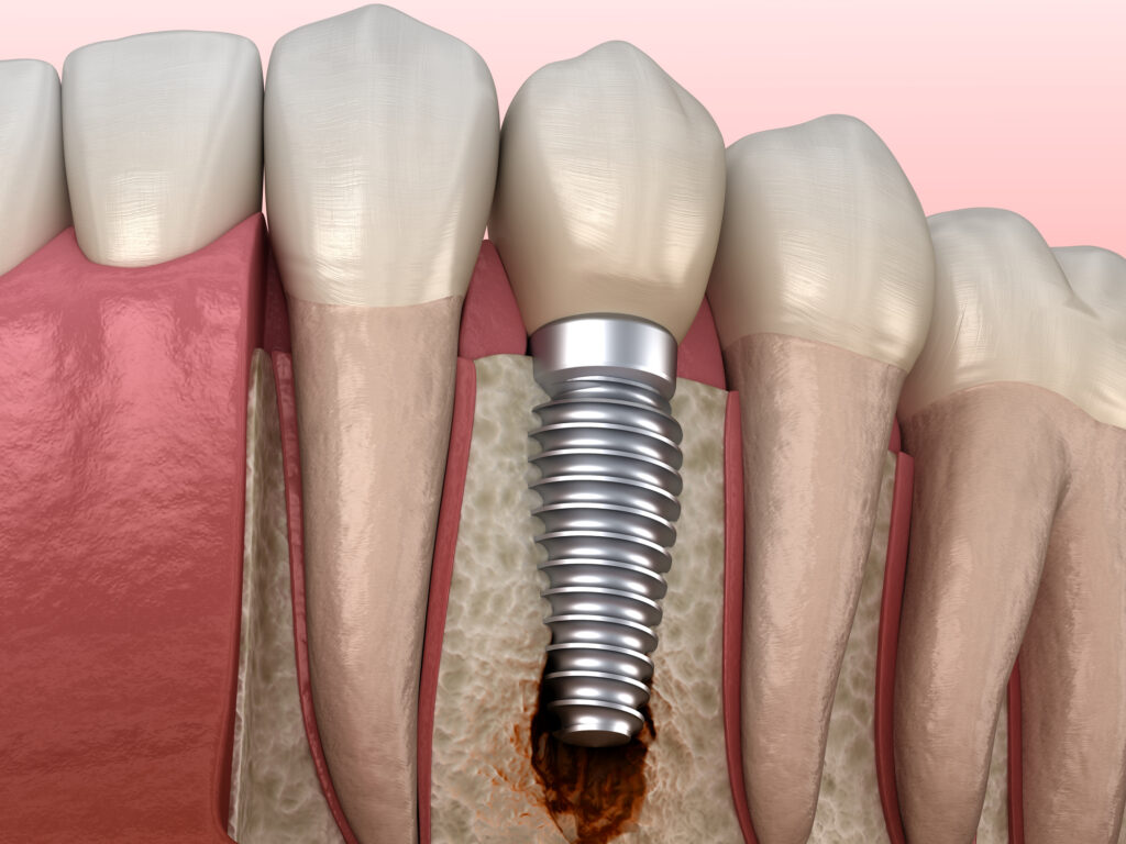 Prevención de periimplantitis