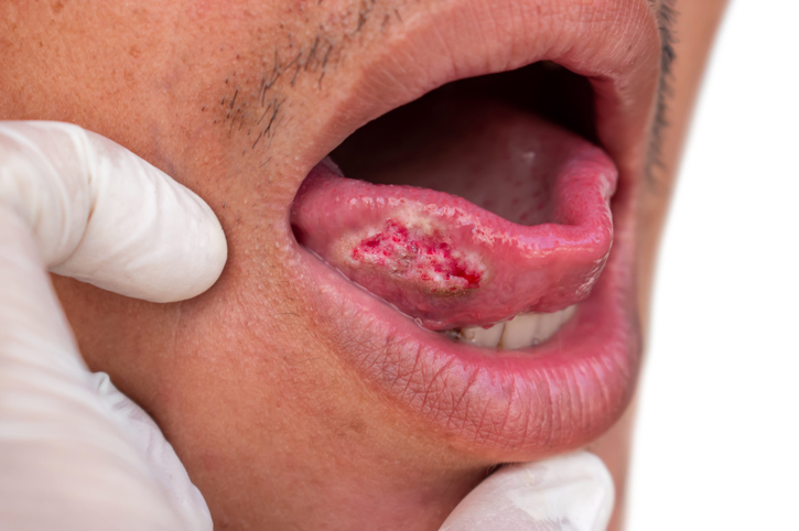 Factores de riesgo del cáncer oral