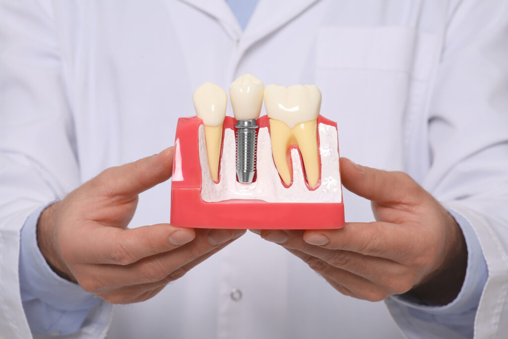cuidar un implante dental