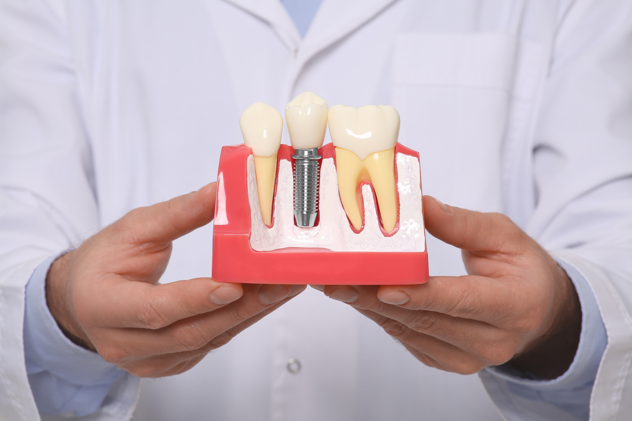 cuidar un implante dental